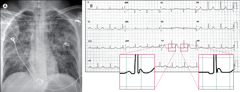 ECG mostró ritmo sinusal con ondas de Osborn clásicas (o ondas J), claramente visibles en la derivación V3